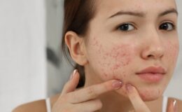 Sivilceler Nasıl Geçer? Sivilcelere Ne İyi Gelir?