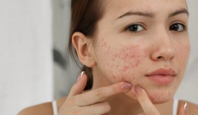 Sivilceler Nasıl Geçer? Sivilcelere Ne İyi Gelir?