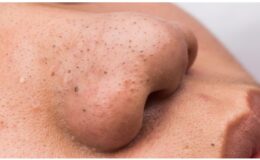 Siyah Noktalar Nasıl Geçer, Evde Temizlenebilir mi?