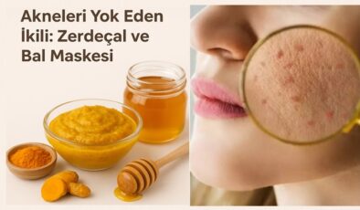 Akneleri Yok Eden İkili: Zerdeçal ve Bal Maskesi