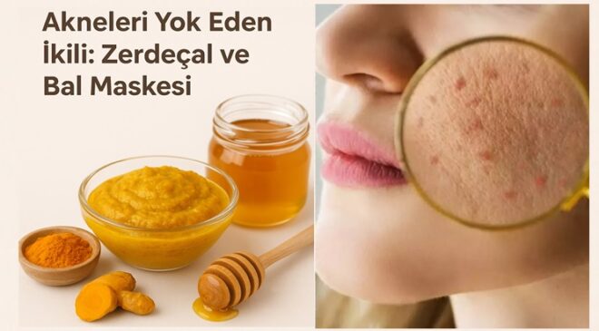 Akneleri Yok Eden İkili: Zerdeçal ve Bal Maskesi